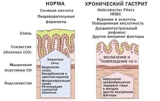 Хронический гастрит. Гастродуоденит. Призыв или отсрочка?